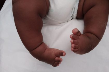 Group seeks better treatment for children with clubfoot