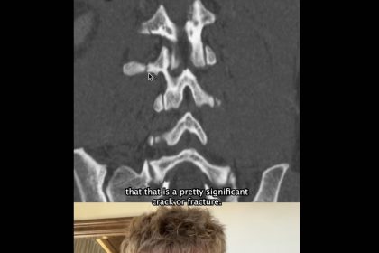 Forrest Frank shows proof of broken back, miraculous healing